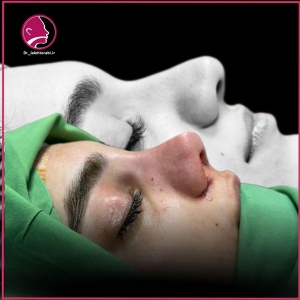 جراحی-بینی-81