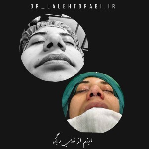 جراحی-بینی-85