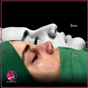 جراحی-بینی-88