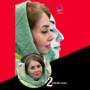 جراحی-بینی-90