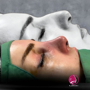 جراحی-بینی-97