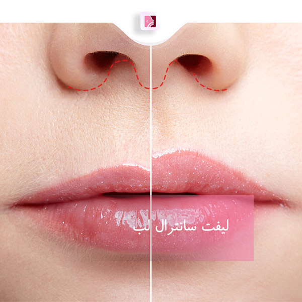 لیفت سانترال لب در رشت - دکتر لاله ترابی