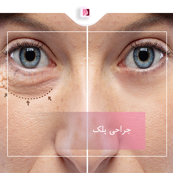 جراحی پلک در رشت - دکتر لاله ترابی