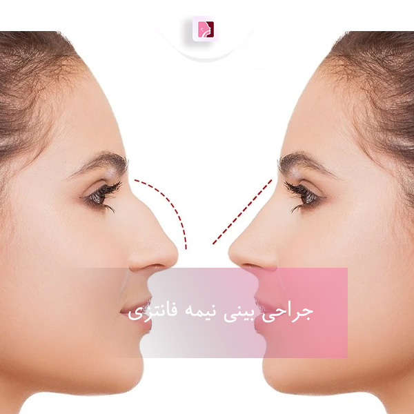 جراحی بینی نیمه فانتزی_دکتر ترابی