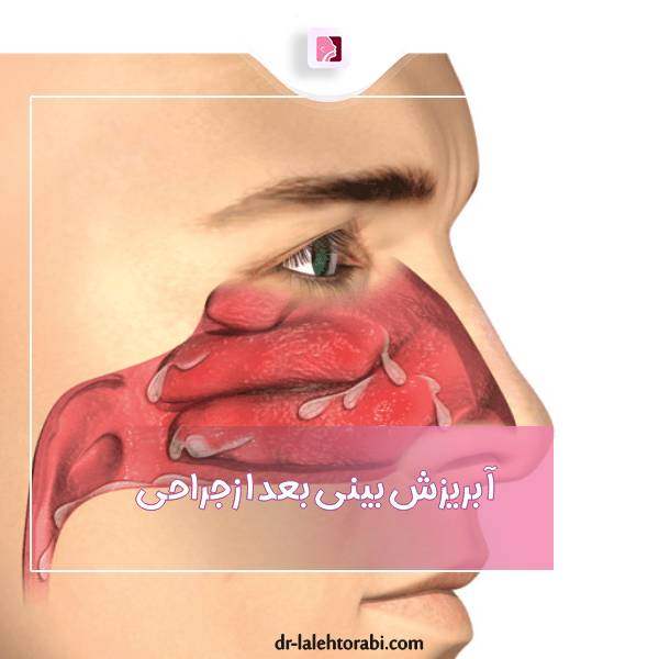 آبریزش بینی بعد ازجراحی بینی