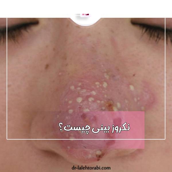 نکروز بینی