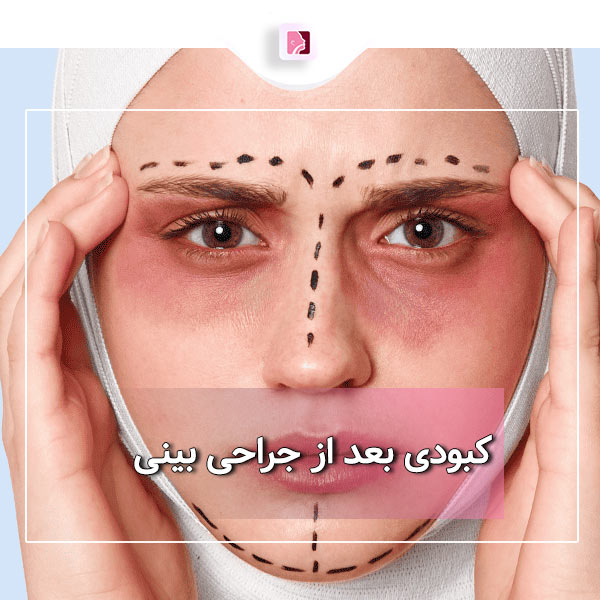 کبودی بعد از جراحی بینی