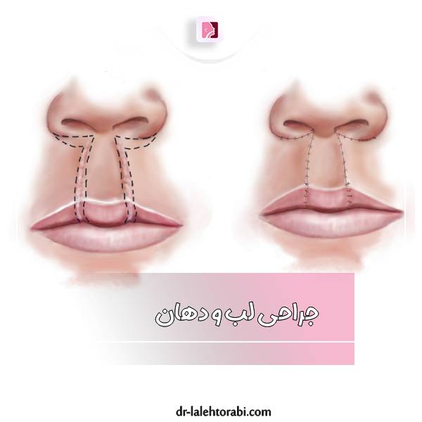 جراحی لب و دهان در رشت