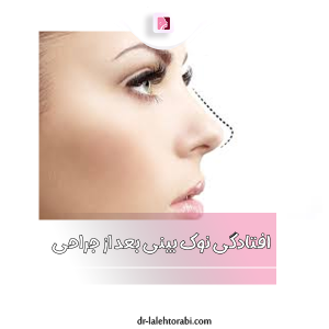 افتادگی نوک بینی بعد از عمل - دکتر لاله ترابی